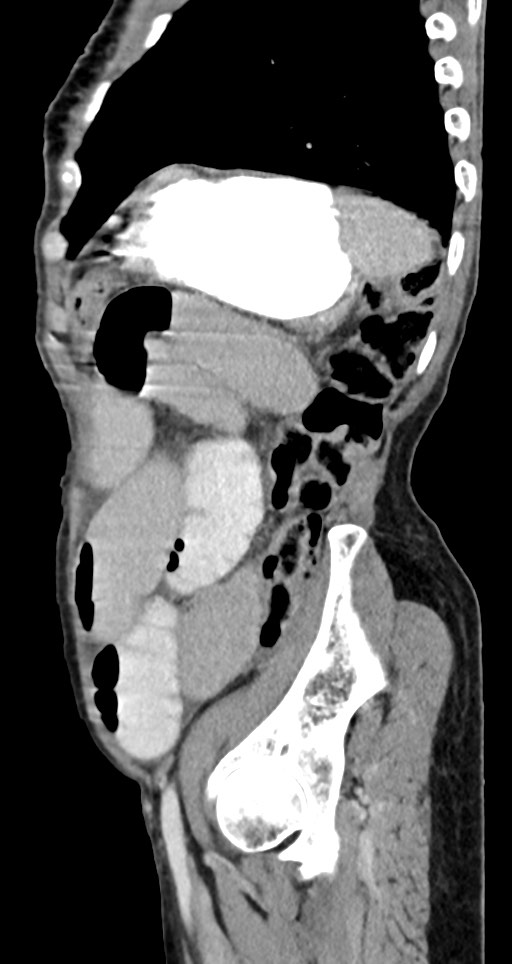 Acute small bowel (ileal) volvulus (Radiopaedia 71740-82139 Sagittal C+ portal venous phase 49).jpg