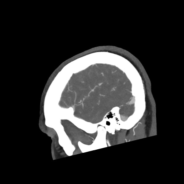 Acute subarachnoid hemorrhage and accessory anterior cerebral artery (Radiopaedia 69231-79009 Sagittal C+ arterial phase 60).jpg