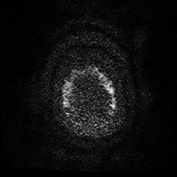 Acute superior cerebellar artery territory infarct (Radiopaedia 84104-99358 Axial DWI 2).jpg