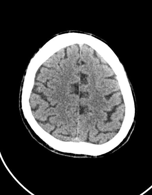 Acute superior cerebellar artery territory infarct (Radiopaedia 84104-99359 Axial non-contrast 20).jpg