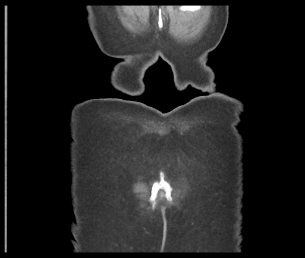 Acute superior mesenteric artery occlusion (Radiopaedia 43926-47418 Coronal C+ portal venous phase 51).png