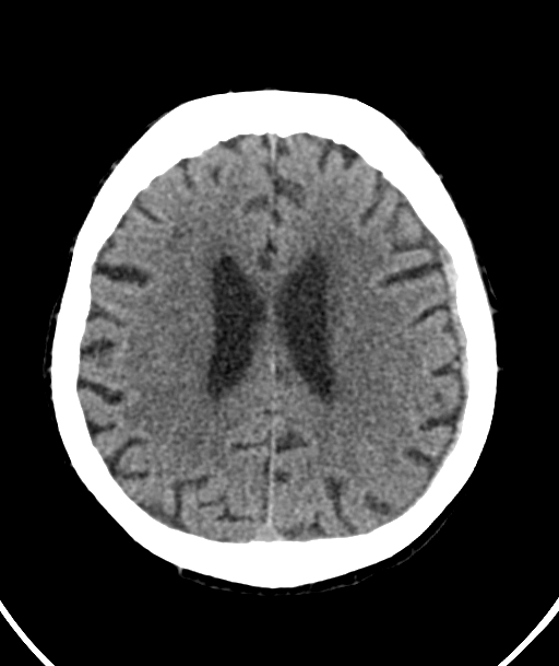Acute traumatic subdural hematoma (Radiopaedia 82921-97257 Axial non-contrast 26).jpg