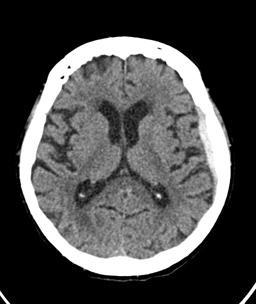 Acute traumatic subdural hematoma (Radiopaedia 82921-97257 Axial non-contrast 33).jpg