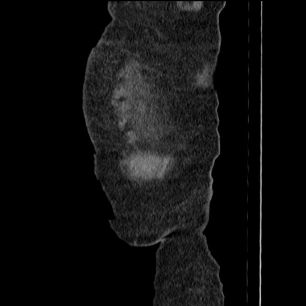 Acute tubular necrosis (Radiopaedia 28077-28334 Sagittal non-contrast 4).jpg