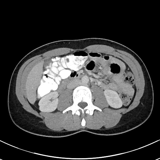Acute uncomplicated appendicitis (Radiopaedia 61374-69304 Axial C+ portal venous phase 53).jpg