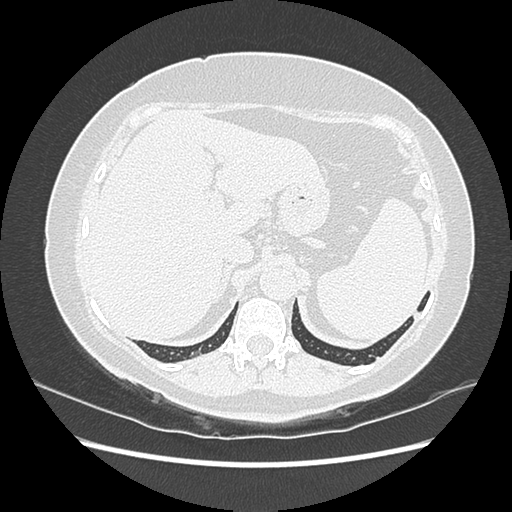 Adenocarcinoma in situ of lung (Radiopaedia 38685-40829 B 208).png