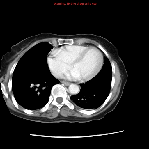 Adenocarcinoma of the colon (Radiopaedia 8191-9039 Axial liver window 3).jpg