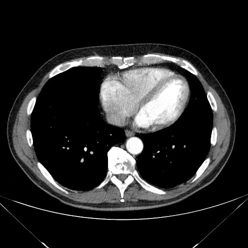 File:Adenocarcinoma of the lung (Radiopaedia 59871-67325 Axial C+ arterial phase 67).jpg