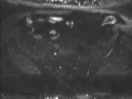 Adenocarcioma of rectum- T1 lesion (Radiopaedia 36921-38546 Axial DWI 26).png