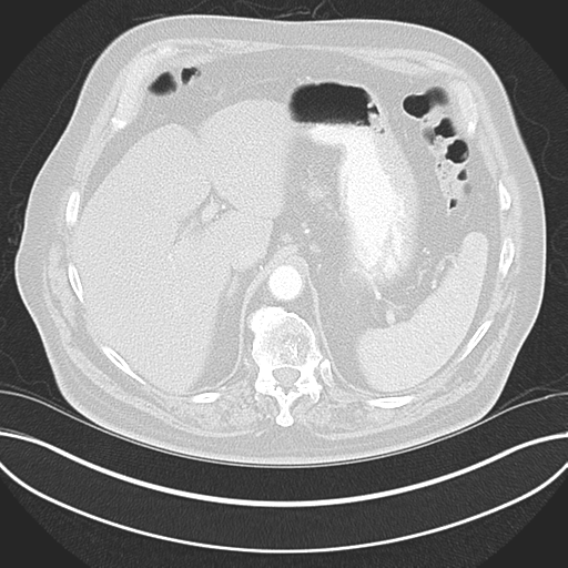 Adenocarcioma of rectum- T1 lesion (Radiopaedia 36921-38547 Axial lung window 53).png