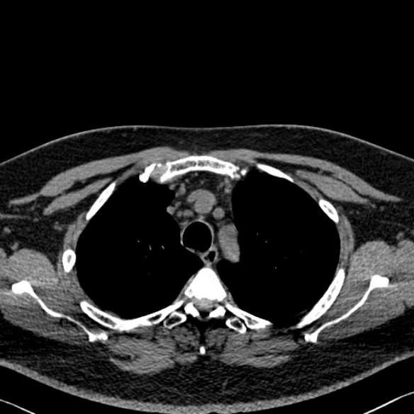 Adenoid cystic carcinoma of the trachea (Radiopaedia 49042-54137 Axial non-contrast 80).jpg