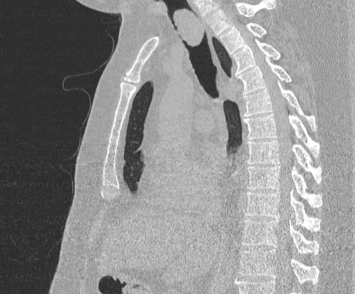 Adenoid cystic carcinoma of the trachea (Radiopaedia 49042-54137 Sagittal lung window 232).jpg
