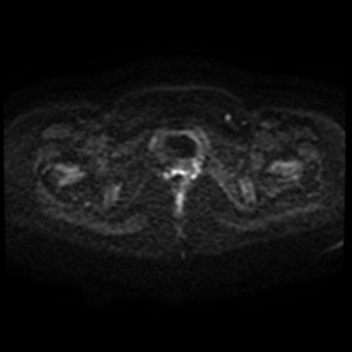 Adenoma malignum of cervix (Radiopaedia 66441-75705 Axial DWI 96).jpg