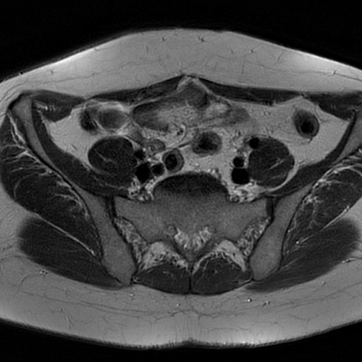 File:Adenomyosis-scar endometriosis (Radiopaedia 65863-75022 Axial T2 4).jpg