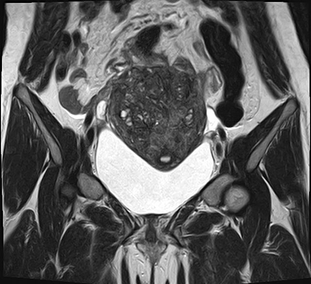 File:Adenomyosis - ovarian endometriomas (Radiopaedia 67031-76350 Coronal T2 10).jpg