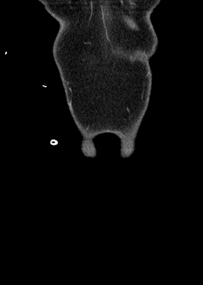 Adhesional small bowel obstruction (Radiopaedia 48397-53305 Coronal C+ portal venous phase 14).jpg