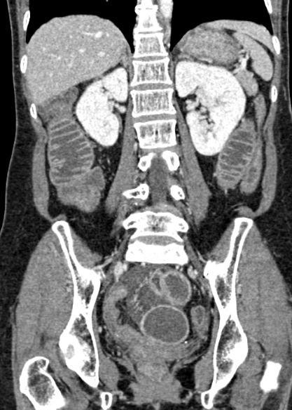 Adhesional small bowel obstruction (Radiopaedia 48397-53305 Coronal C+ portal venous phase 229).jpg