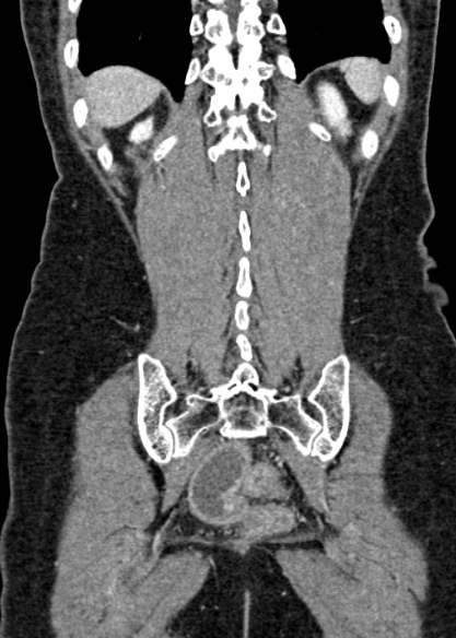 Adhesional small bowel obstruction (Radiopaedia 48397-53305 Coronal C+ portal venous phase 293).jpg