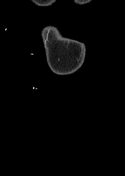 File:Adhesional small bowel obstruction (Radiopaedia 48397-53305 Coronal C+ portal venous phase 5).jpg