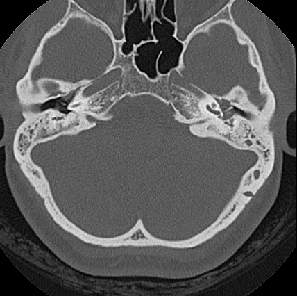 File:Adhesive chronic otitis media (Radiopaedia 14270-14148 Axial bone window 9).jpg