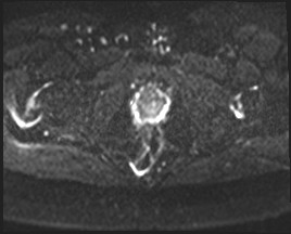 Adnexal multilocular cyst (O-RADS US 3- O-RADS MRI 3) (Radiopaedia 87426-103754 Axial DWI 22).jpg