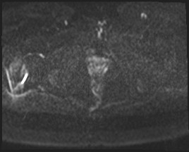 Adnexal multilocular cyst (O-RADS US 3- O-RADS MRI 3) (Radiopaedia 87426-103754 Axial DWI 54).jpg