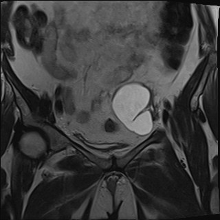 File:Adnexal multilocular cyst (O-RADS US 3- O-RADS MRI 3) (Radiopaedia 87426-103754 Coronal T2 11).jpg