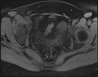 File:Adnexal multilocular cyst (O-RADS US 3. O-RADS MRI 3) (Radiopaedia 87426-103754 Axial 186).jpeg