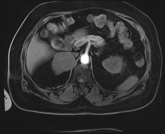 Adrenal cortical carcinoma (Radiopaedia 64017-72770 Axial T1 C+ fat sat 12).jpg