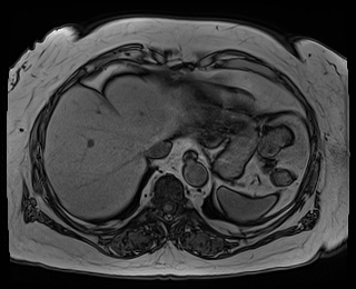 File:Adrenal cortical carcinoma (Radiopaedia 64017-72770 Axial T1 out-of-phase 5).jpg