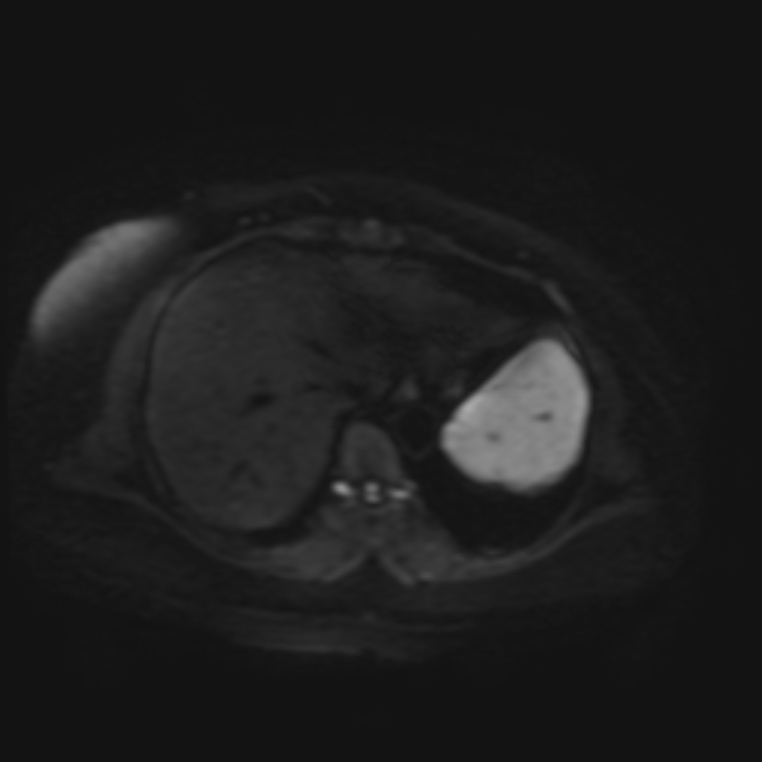 Adrenal cortical carcinoma (Radiopaedia 70906-81116 Axial DWI 4).jpg