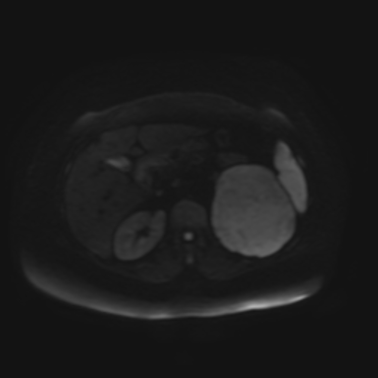 Adrenal cortical carcinoma (Radiopaedia 70906-81116 Axial DWI 40).jpg