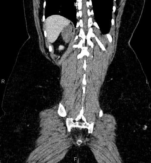 Adrenal cortical carcinoma (Radiopaedia 84882-100379 Coronal C+ portal venous phase 56).jpg