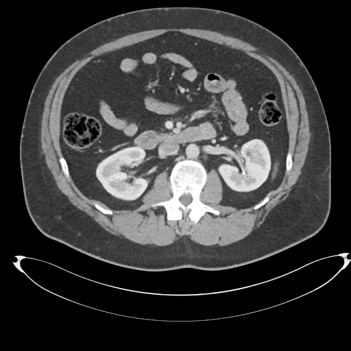 File:Adrenal cyst (Radiopaedia 45625-49778 AXIAL THICK 60 sec 38).png
