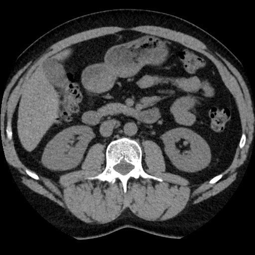 File:Adrenal gland trauma (Radiopaedia 81351-95079 Axial non-contrast 48).jpg