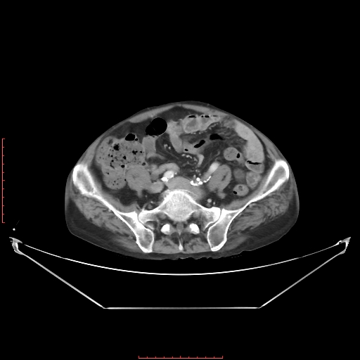 Adrenal hemangioma (Radiopaedia 68923-78668 Axial C+ portal venous phase 51).jpg