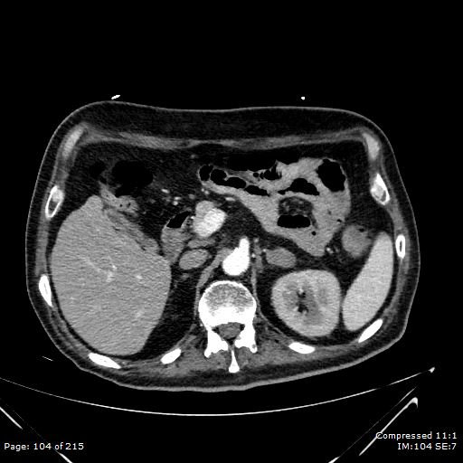 Adrenal metastasis (Radiopaedia 78425-91079 Axial C+ arterial phase 34).jpg