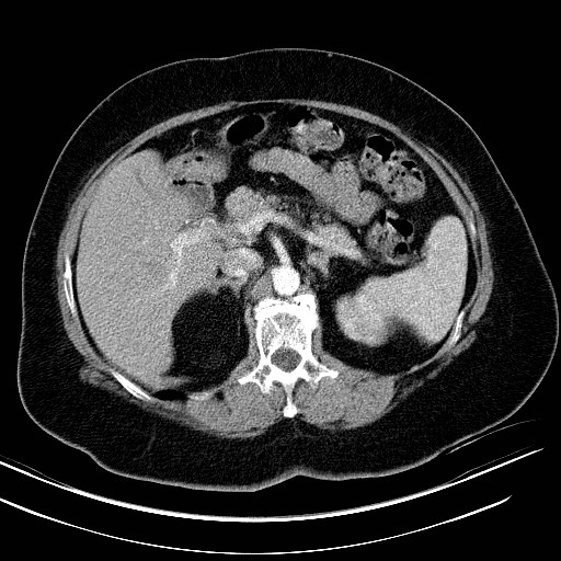 File:Adrenal myelolipoma (Radiopaedia 25413-25655 Axial C+ arterial phase 1).jpg