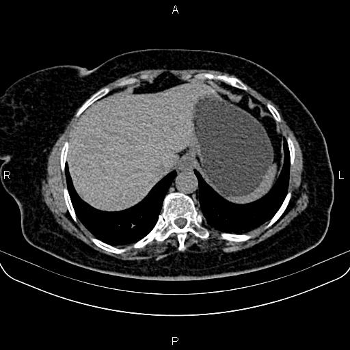 Adrenal myelolipoma (Radiopaedia 82742-96986 Axial non-contrast 17).jpg