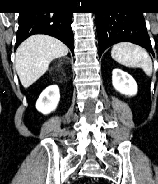 Adrenal myelolipoma (Radiopaedia 82742-96986 Coronal renal cortical phase 56).jpg