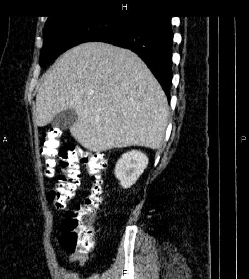 Adrenal myelolipoma (Radiopaedia 84319-99617 Sagittal renal cortical phase 20).jpg