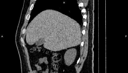 Adrenal myelolipoma (Radiopaedia 84321-99619 Sagittal non-contrast 22).jpg