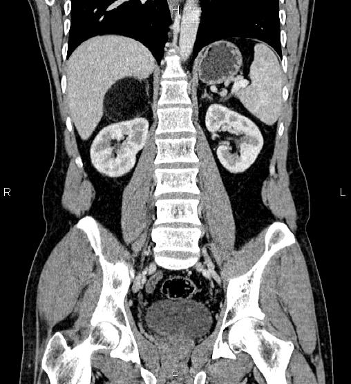 Adrenal myelolipoma (Radiopaedia 87794-104246 Coronal renal cortical phase 41).jpg