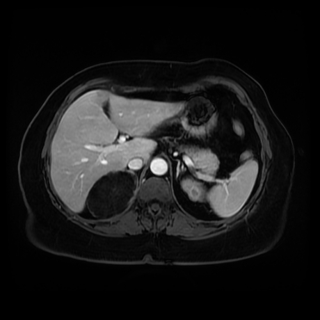 Adrenal myelolipoma - MRI (Radiopaedia 83249-97646 T1 fat sat arterial phase 25).jpg
