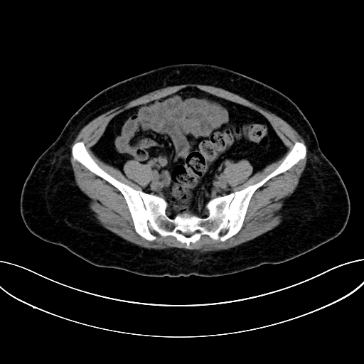 Adrenocortical carcinoma (Radiopaedia 87281-103569 Axial non-contrast 67).jpg