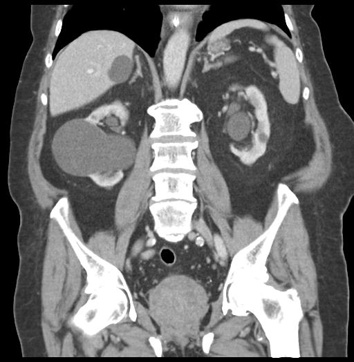Adult ileal intussusception with secondary obstruction (Radiopaedia 30395-31051 Coronal C+ portal venous phase 39).jpg
