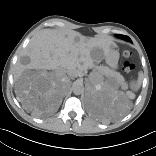 File:Adult polycystic kidney disease (Radiopaedia 47866-52626 Axial non-contrast 17).png