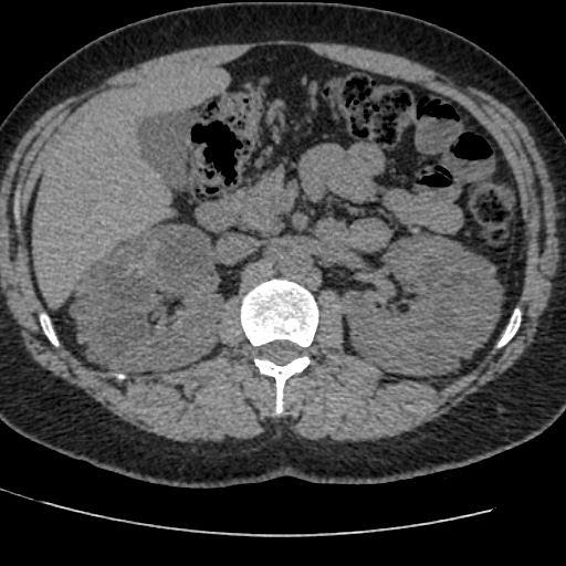 Adult polycystic kidney disease (Radiopaedia 59075-66368 Axial non-contrast 26).jpg