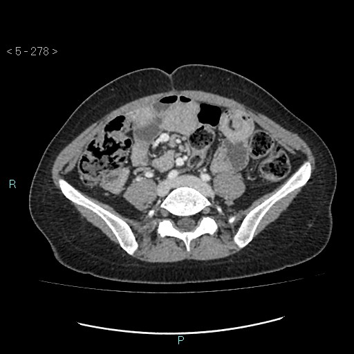 Adult transient intestinal intussusception (Radiopaedia 34853-36310 Axial C+ portal venous phase 62).jpg