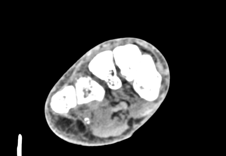 Advanced osteomyelitis due to open metatarsal fracture (Radiopaedia 83891-99095 Axial non-contrast 23).jpg